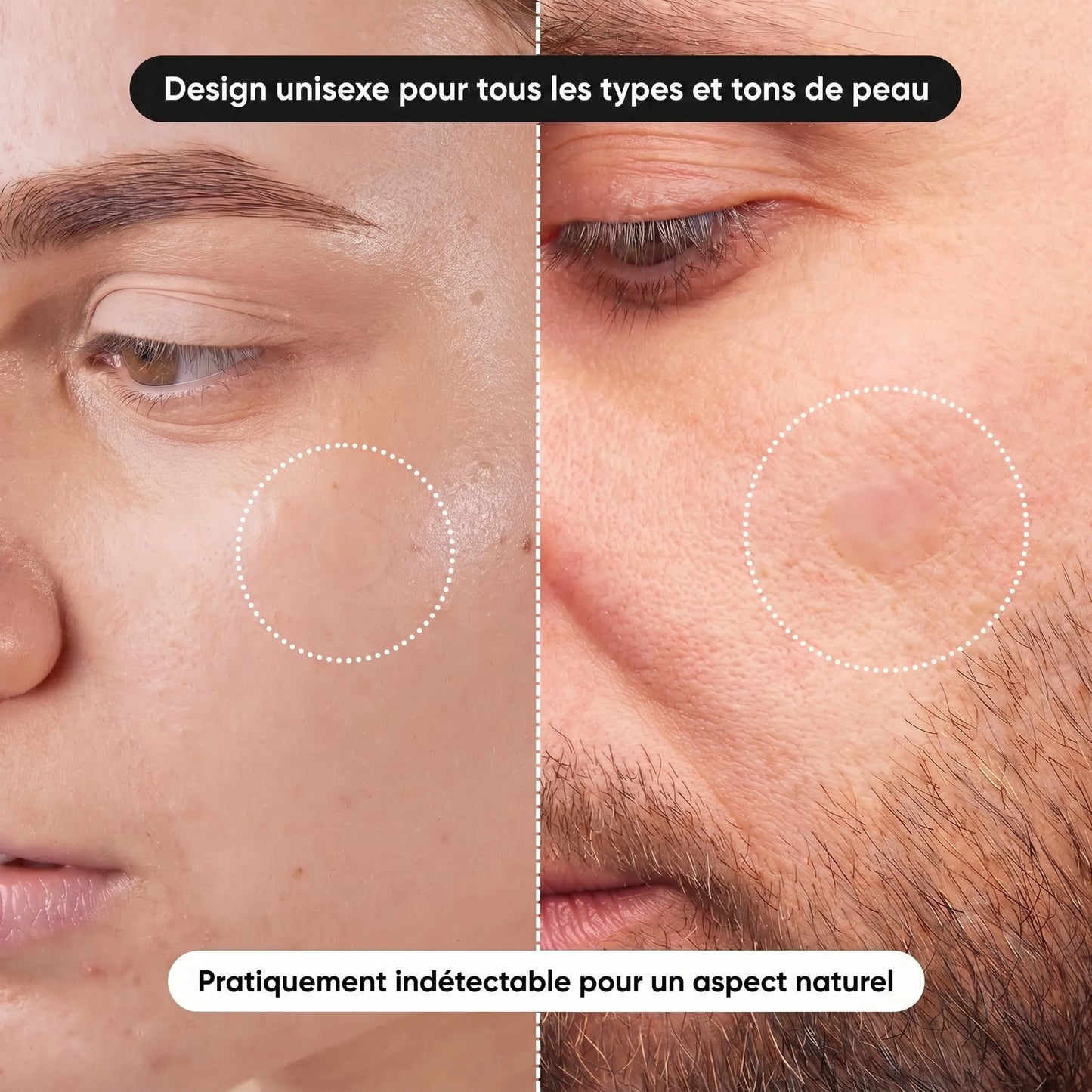 Patchs anti-acné hydrocolloïdes doux